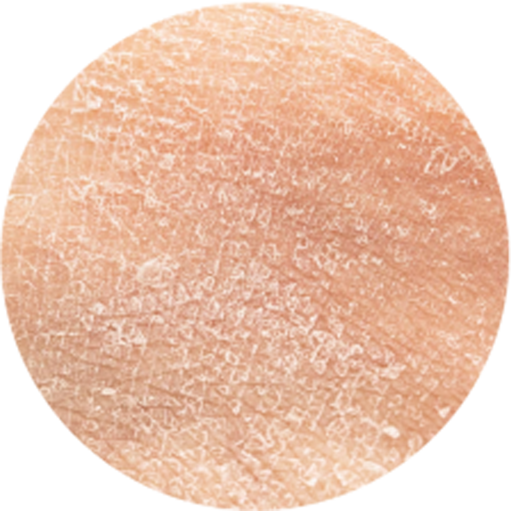 Dry-Rough-Skin